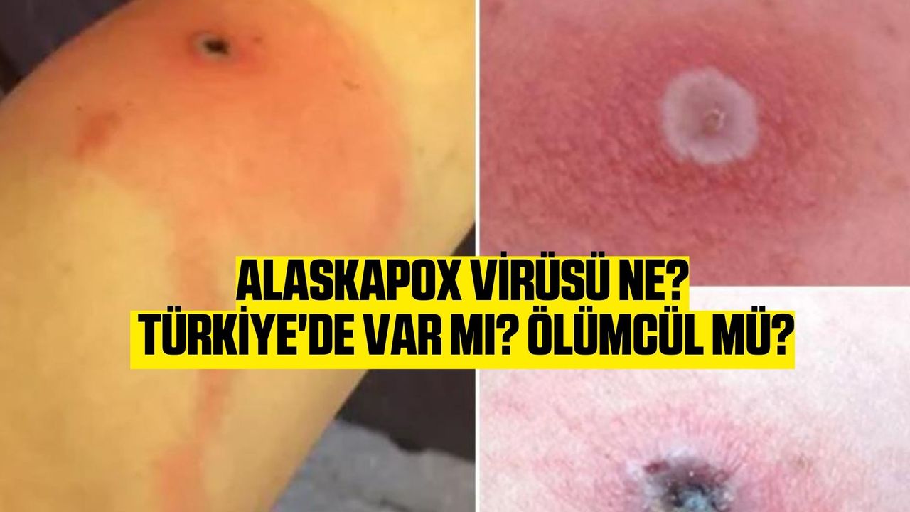 Alaskapox virüsü ne? Türkiye'de var mı? Ölümcül mü?