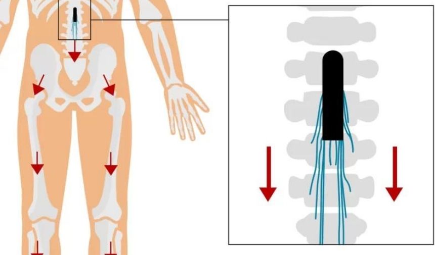 Parkinson implantı insana yürüme yeteneğini geri kazandırıyor (1)
